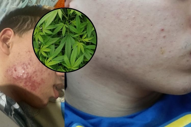 Emulsiones hidrosolubles tópicas con cannabinoides para el tratamiento del acné